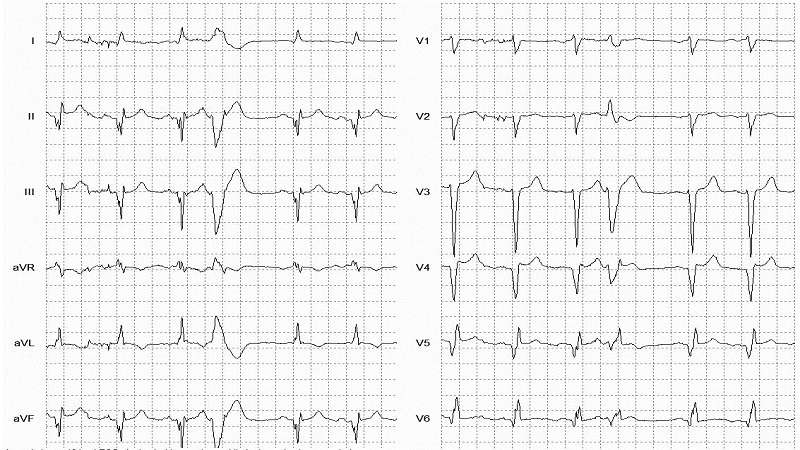 VEB Unspecified Morphology 12 Lead EKG